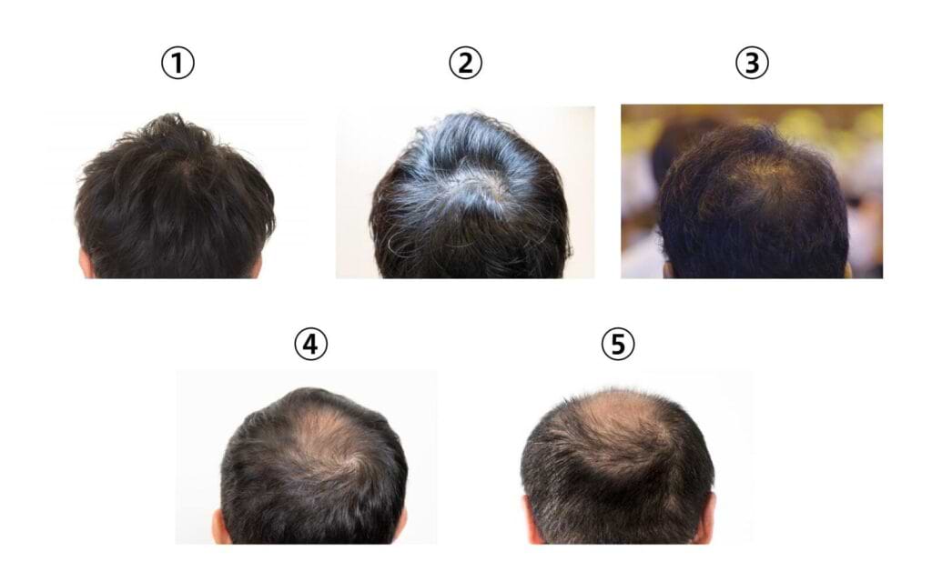 医師監修 つむじはげの基準ってどこから 見分け方や改善対策を解説 Vitabridc12 Hair